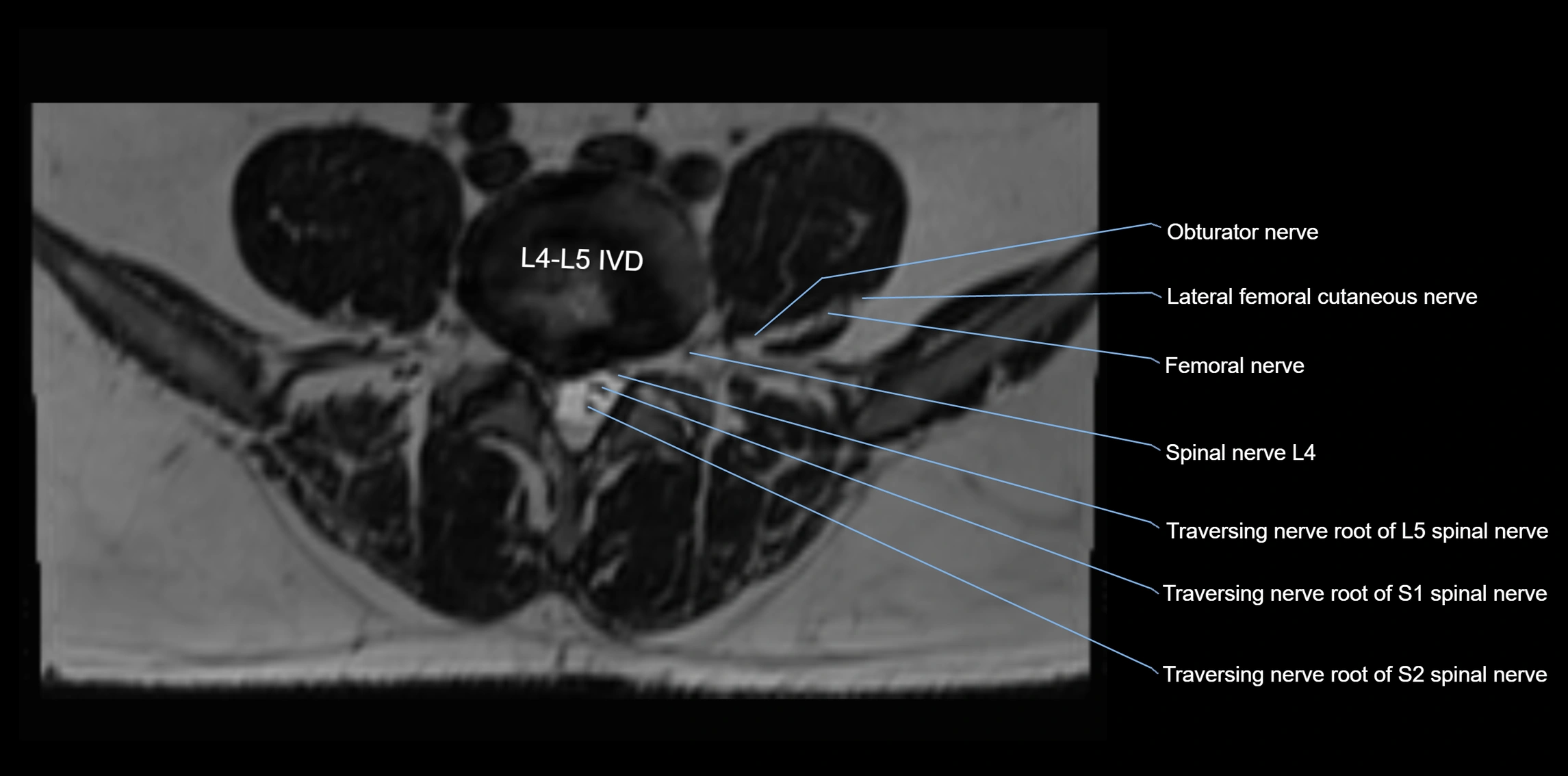 MR lumbosacral plexus axial cross sectional anatomy 3T  radiology  image-img-1008001-00047.webp